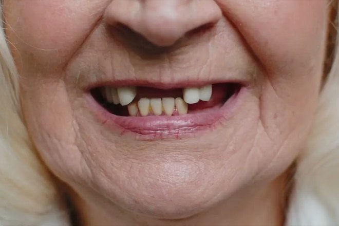 Улыбка пациента до имплантации: отсутствуют передние зубы